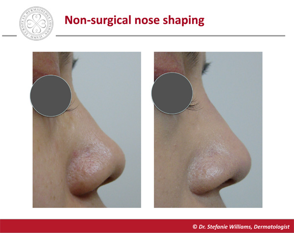 Non-Surgical Nose Reshaping